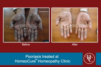 Testimonial of psoriasis of hands treated at HomeoCure Clinic, Pune